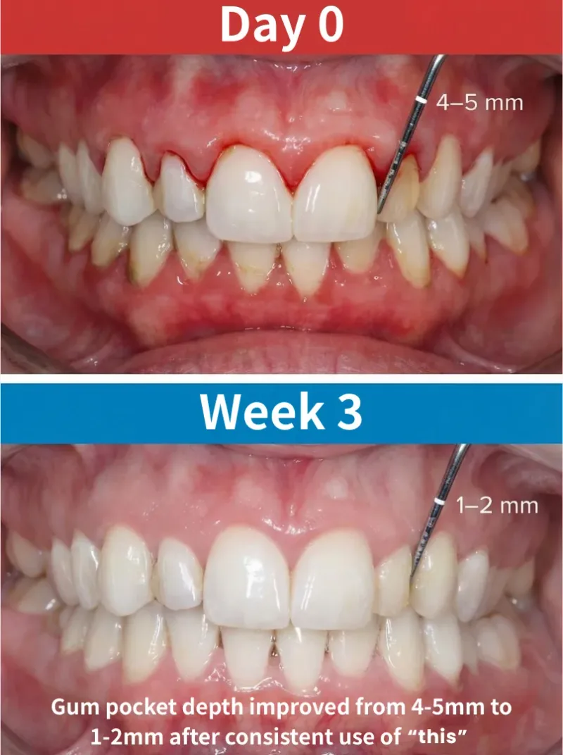 Gum pocket improvement diagram